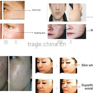 Hot Sale Fractional rf Needling Skin Rejuvenation Wrinkle Removal Beauty Equipment Supplier thumbnail-5