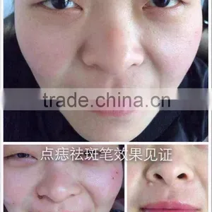 Spot Removal Machine , Freckle Removal Machine $260/pcs ,without Shipping thumbnail-3