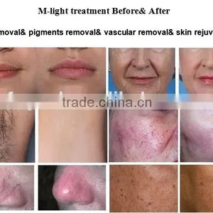 Super Hair Removal Machine With IPL SHR Elight OPT From Beijing Fogool thumbnail-5