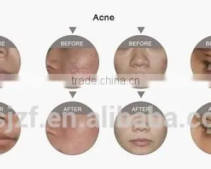 Wrinkle Removal Vertical F7 Co2 Fractional Laser For 8.0 Inch Wrinkle Spot Scar Pigment Removal Equipment/medical Fractional Co2 Laser thumbnail-6