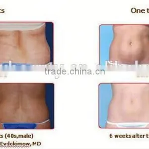 High Quality Portable Fat Freezing Fat Freeze Slimming Beauty Device For Sale thumbnail-6