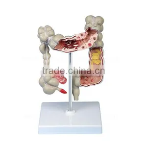 Pathology Colon Model Organs Human Body Anatomy thumbnail-2