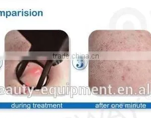 RF Pipe Fractional Co2 Carboxytherapy Laser Vaginal Tightening Machine Treat Telangiectasis thumbnail-4