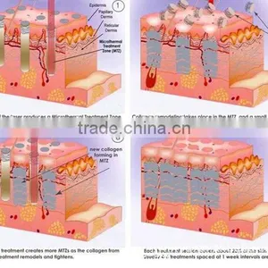 Portable 40W RF Tube Pixel Co2 Fractional Laser With Virginal Tightening thumbnail-4