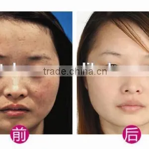 1 HZ Q Switch Nd Yag Laser Tattoo Q Switch Laser Machine Removal Skin Rejuvenation Machine Tattoo Laser Removal Machine thumbnail-3