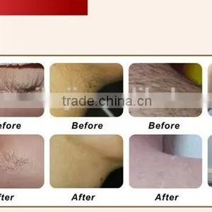 Skin Lifting Professional Ipl Hair Removal And Facial Rejuvenation Machine Hair Removal thumbnail-2