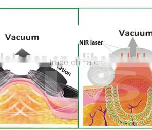 High Frequencyfat Burning Newest Big Fat Cavitation Machine Promotion Cavitation Machine/ultrasonic Cavitation/cavitation Slimming Machine Ultrasonic Liposuction Machine thumbnail-3