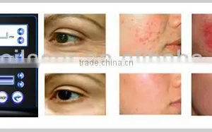 2015 Most Popular Fractional rf Beauty Device for All Kinds Wrinkle Remomal thumbnail-5