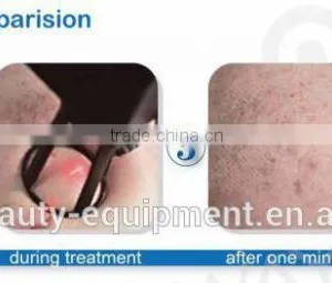 Ultra Pulse Pigmentation Removal CO2 Laser Resurfacing Machine thumbnail-5