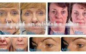 HIFU-C HIFU Wrinkle Removal Equipment thumbnail-4
