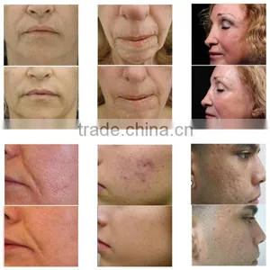 Salon Use E-matrix RF Skin Rejuvenation Fractional RF Micro Needle Machine thumbnail-6
