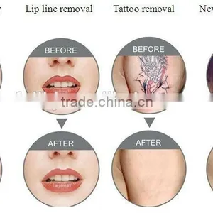 Portable Tattoo Removal Machine thumbnail-3
