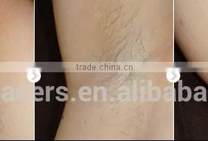 High Efficiency Shr Ipl Hair Removal/laser Hair Removal Machine Price thumbnail-6