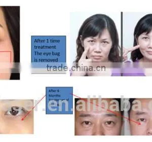 New Products 2016 Dark Eye Circle Removal Eye Beauty Machine thumbnail-6