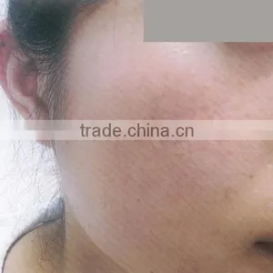 Cooling Comfortable Ipl Elight Machine Hair Removal and Skin Rejuvenation System thumbnail-6