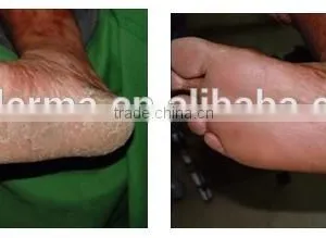 UVB Narrow Band (NB) PL-S 9W/01 311nm Lamps, Hand Held UVB Therapy Lamp thumbnail-2