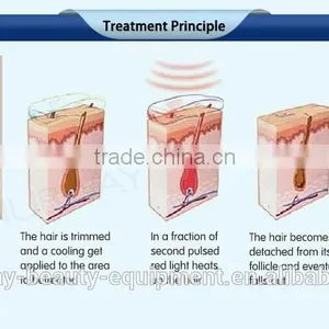 2017 New Design Laser Diodo Hair Removal/ Electric Hair Removal Machine Epilator/Nubway Laser Hair Removal Equipment for Sale thumbnail-5