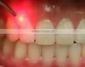 Portable Medical Dental Laser Equipment thumbnail-5