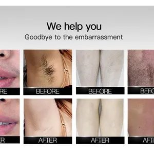 808nm Diode Laser Hair Removal Machine With 755nm 808nm 1064nm Triple Wavelength, 1200W Power, Sapphire Cooling Touch Screen thumbnail-4