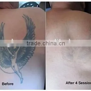 CE Approved Picosure Fractional Q-switched Laser for Big Tattoo Removal thumbnail-5