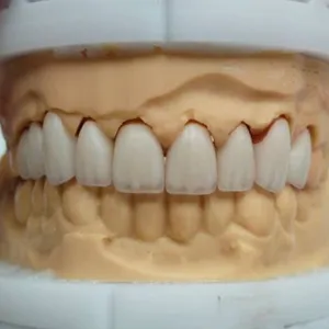 Zirconia Metal Crown America Outsourcing Dental Lab thumbnail-1