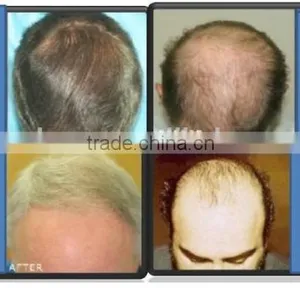 650nm Diode Laser PDT Led Laser Hair Growth For Hair Loss Treatment thumbnail-5