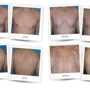 808nm Diode Laser Hair Removal Machine With 755nm 808nm 1064nm Triple Wavelength, 1200W Power, Sapphire Cooling Touch Screen thumbnail-3