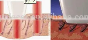 Laser Diode Hair Removal Lead a Permanet Effect /808nm Diode Laser Hair Remover thumbnail-4
