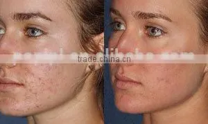 Spot Scar Pigment Removal Fractional Co2 Fractional Laser Vaginal Tightening Medical Treat Telangiectasis & Acne Scar Removal Machine CO2 Laser Skin Renewing thumbnail-4