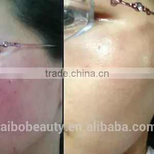 Distributor Low Price ! 980nm Spider Vein Removal Machine Vascular Remover 980 Varicose Vein Laser thumbnail-3