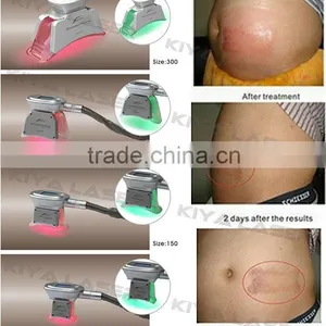 Most Popular Slimming! Cool Lipo Machine thumbnail-3