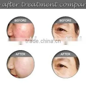 2015 Hot IPL Elight SHR Three in One Permanent Hair Removal Machine With CE Approved for Skin Rejuvenation and Hair Removal thumbnail-5