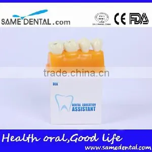 Pit and Fissure Model Dental Eduction Assitant No. DEA-19 thumbnail-4