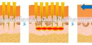 2015 New Product Medical CE Approval Microneedle Fractional RF for Skin Rejuvenation thumbnail-4