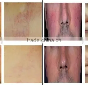 Professional Facial Vein Redness Removal Leg Spider Vein Removal Machine/ Most Advanced High Power Vascular Removal thumbnail-6