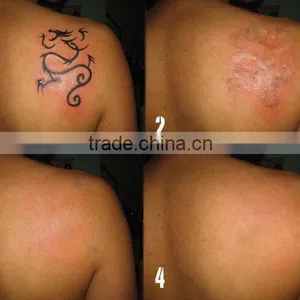 Home Use Portable q Switch Tattoo Removal 1064/532nm 1320nm nd Yag Laser thumbnail-6