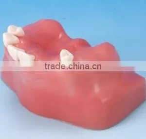 Factory Price Clinical Drill Model Cableway/ Dental Implant Model/implantes for Teeth thumbnail-1