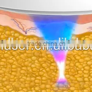 2015 Liposonix Treatment Comfortable Weight Loss Face Lift EShape Multifunction Beauty Machine thumbnail-4