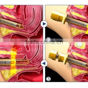 2016 Good Effect 25mm Focal Length Hifu Vaginal Tightening Machine With CE Certificate thumbnail-6