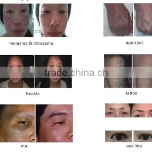 2016 New Touch Screen Tattoo Removal Machine nd Yag Laser Machine Prices thumbnail-4