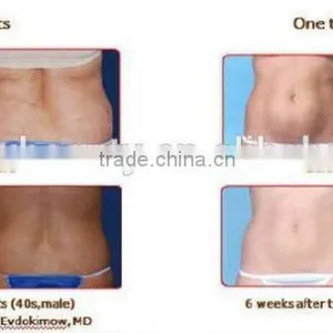 Touch Screen Fat Freezing Fat Loss Machine/fat Freezing Slimming Beauty Equipment /CE(hot in USA) thumbnail-6