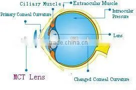 For Low Myopia MCT Technology High Technology thumbnail-1