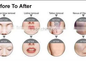 Discount Screen Logo Customized Nd Yag Laser Hair Removal Nd Yag Laser Ipl thumbnail-3