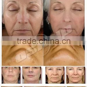 Fast Result Yag Laser Machine Acne Facial Treatment thumbnail-6