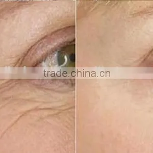 RF Fractional Micro Needle / Fractional rf Wrinkle Removal Machine / Fractional rf thumbnail-6