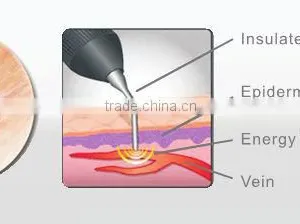 China Hair Salon Equipment Vascular Spider Vein Removal Machine thumbnail-3