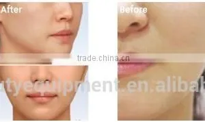 Fractional rf Wrinkle Removal Machine Skin White Whitening Cream thumbnail-6