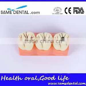 4 Times the Cavities Progress Model Dental Eduction Assitant No. DEA-16 thumbnail-1