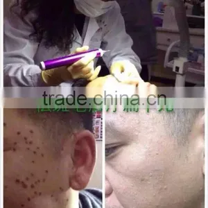 Tattoo Removal Machine for Wholesale thumbnail-1