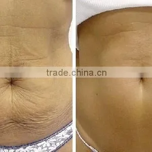Cool Sculpting 2016 Wonderful Cryolipolysis Body Reduce Cellulite Slimming Machine/fat Freezing Beauty Machine thumbnail-3